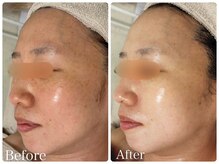 ロイヤル(ROYAL)/シミ/くすみ改善症例