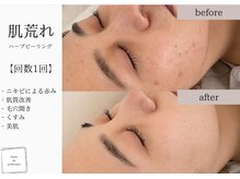 サロン ド パーフェクション(Salon de Perfection)/ハーブピーリング