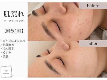 サロン ド パーフェクション(Salon de Perfection)/ハーブピーリング