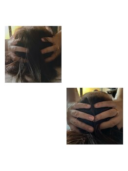 クシェル(kuschel)/耳介筋膜リリース