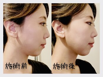 あくび 西麻布(aqu美)/フェイシャル,小顔調整,美容鍼