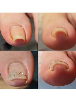 オルトグリップシュパンゲ