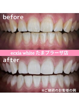 エクシアホワイトニング たまプラーザ店/ビフォーアフター