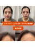 リフトアップ、しわたるみ改善小顔美人魔女美鍼３ヶ月集中お試しコース4400円
