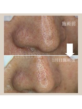 ククナ(kukuna)/毛穴悩みを改善したい！