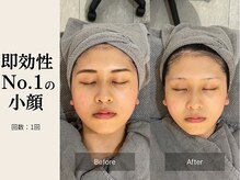 サロン ルイス アディクト(salon Lewis Addict)/小顔リフト