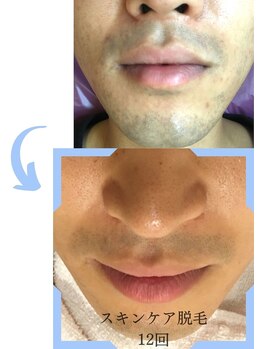 ミックスアップ 池袋店(Mix up!!)/肌をキレイにする脱毛の効果