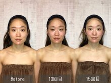 より小顔変化を実感して頂けるように、Before After写真を撮影★