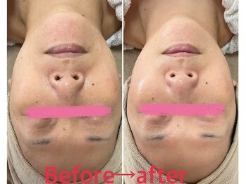 マイラサロン(MAIRA SALON)/ゼオライト水素マスク施術☆