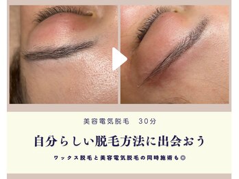 アール ピヴォワンヌ(R.pivoine)/電気脱毛●点で脱毛するイメージ