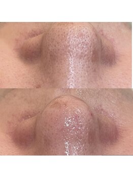 ルナート(Lunart)/毛穴洗浄/毛穴ケア