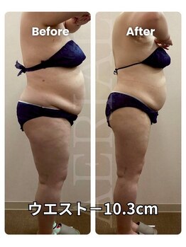 エアリアル 武雄店/脂肪冷却(お腹集中)