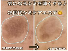 アルページュ(Arpege)/蓄積タイプのお顔ドットをお掃除