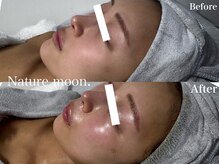 ナチュールムーン(Nature moon.)/ハーブピーリング