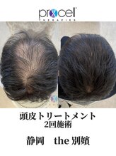 ザ ベッピン(the 別嬪)/頭皮は提携美容院にて施術可能