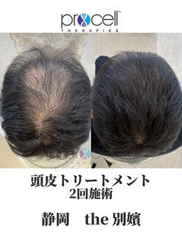 ザ ベッピン(the 別嬪)/頭皮は提携美容院にて施術可能