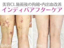 オリエンタルローザ 表参道(Oriental Rosa)の雰囲気（インディバER200で術後のアフターケアお任せ下さい♪顔も身体も!）