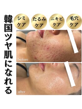 グランデ(Grande)/大人気ハーブピーリング