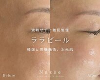 ナッセ(Nasse)