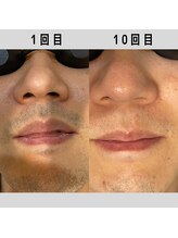 パーミル(per mille‰)/Before/After