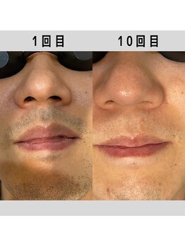 パーミル(per mille‰)/Before/After