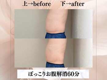 イヨヨ(iyoyo)/【痩身】Before After