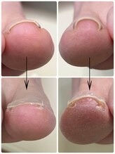 名古屋駅前巻き爪センター/巻き爪