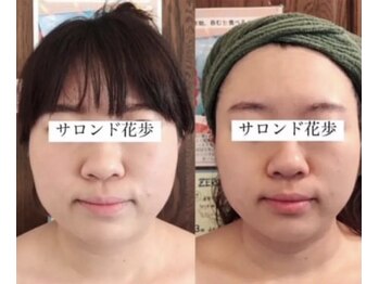 サロン ド 花歩 松山本店/小顔キャビエステ☆施術１回