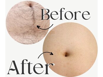 エアリアル 武雄店/メンズ人気!へそ周りの脱毛!