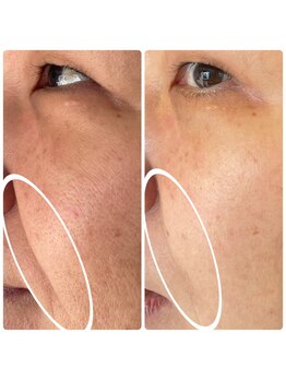 楚々(SOSO)/before after1回目