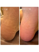 ユープラス(YU+)/角質ケア