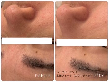 メゾンリュバン 梅田店(Maison Ruban)/ハーブピーリング・水光ジェット