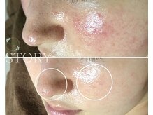 ストーリー(STORY)/ハーブピーリング専門店STORY