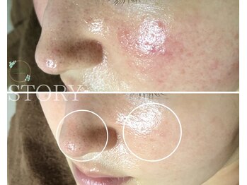 ストーリー(STORY)/ハーブピーリング専門店STORY