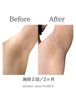 プランツ(PLANTS)/メンズ脇脱毛