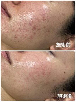 カピリナ(kapilina)/ハーブピーリング施術効果