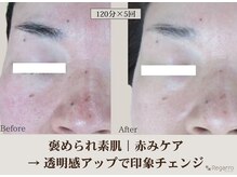 レガロビューティクリエイションズ桜川店/褒められ素肌│赤みケア