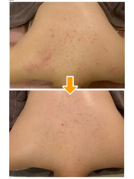 アンプリール(emplir)/ 背中の肌トラブル改善に!