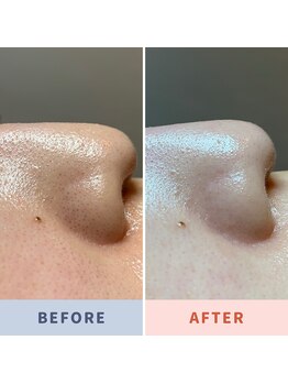 ソリス ビューティー(SOLIS BEAUTY)/毛穴洗浄