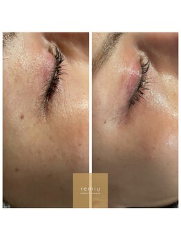 レミュー(remiu)/小顔&目元ヒアルロン酸