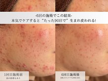 ホクビューティー(HOCU BEAUTY)の雰囲気（ニキビにお悩みの方へ！原因を突き止め根本から攻めのケアを◎）