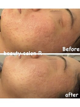 ビューティサロン アール(R)/赤みやゴワつき肌も改善
