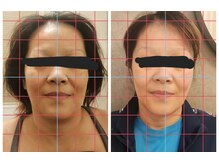 チルアウト 豊見城(Chill out)/小顔矯正ビフォアフター