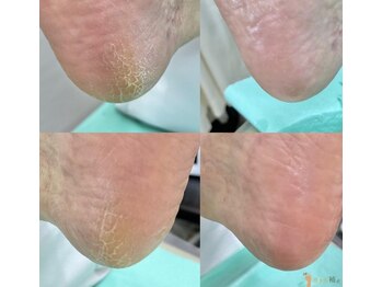 巻き爪補正店 豊田店/【かかとの角質ケア】