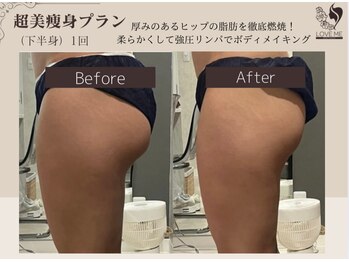 ラブミー 渋谷本店(LoveMe)/骨盤矯正/ハイパーナイフEX/痩身