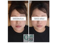 キュープ 大分店(Qpu)/1-5回Before＆After