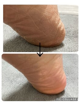 ノーマコルポ(noma corpo)/カサカサ角質を除去