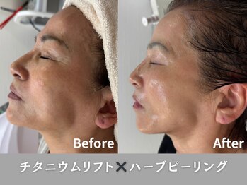イロハ(IROHA)の写真/年齢を感じない若々しいお顔へ*年齢を重ねるたびに気になるお顔のたるみに!エステ以上の仕上がりをご提供♪