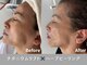 イロハ(IROHA)の写真/年齢を感じない若々しいお顔へ*年齢を重ねるたびに気になるお顔のたるみに!エステ以上の仕上がりをご提供♪