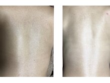 ベル(Belle+vi)/背中脱毛♪